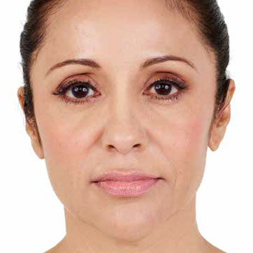 Abbey After Juvederm