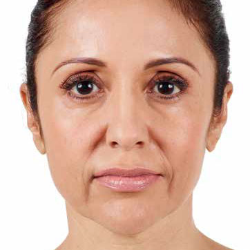 Abbey Before Juvederm