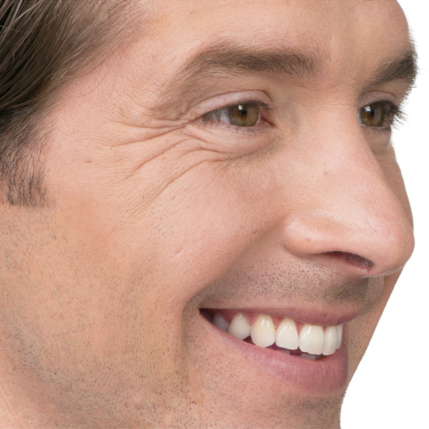 Before Botox Jim