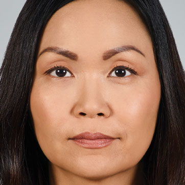 JoyceAfter Juvederm