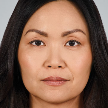 Joyce Before Juvederm