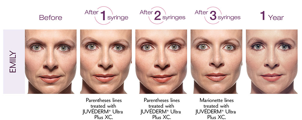 Juvederm Results