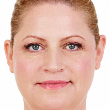 Laura After Juvederm