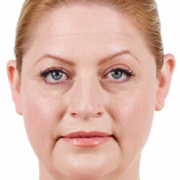Laura Before Juvederm