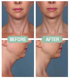 Before & After Photos