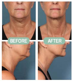 Before & After Photos
