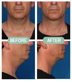 Before & After Photos