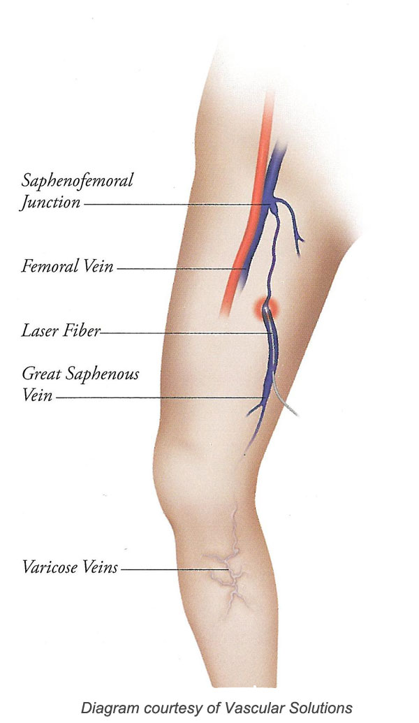 endovenous laser ablation