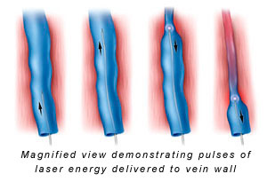 laser ablation