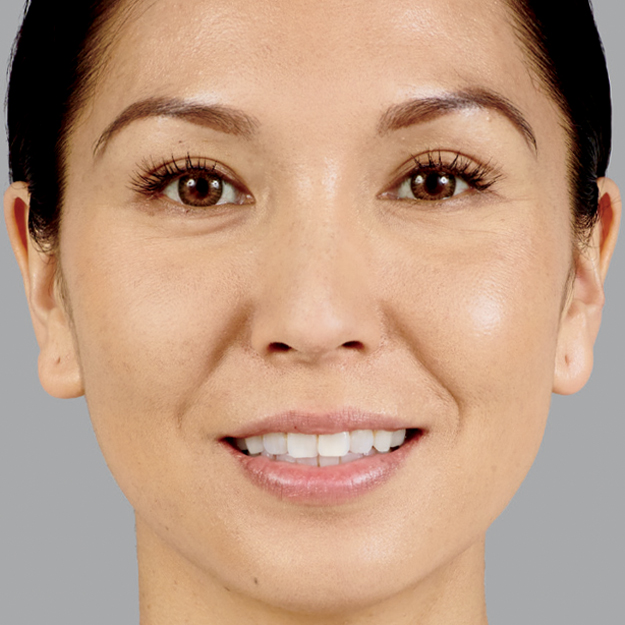 Leslie After Voluma