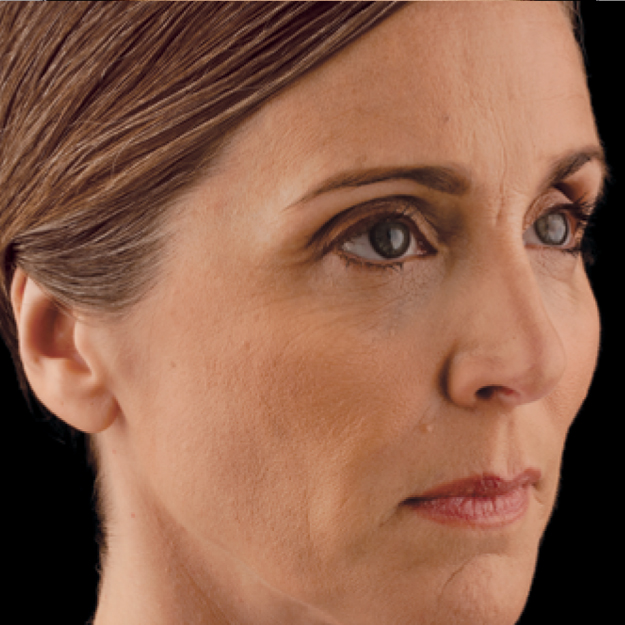 Kathy Before Voluma