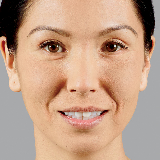 Leslie Before Voluma