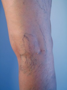 spider veins
