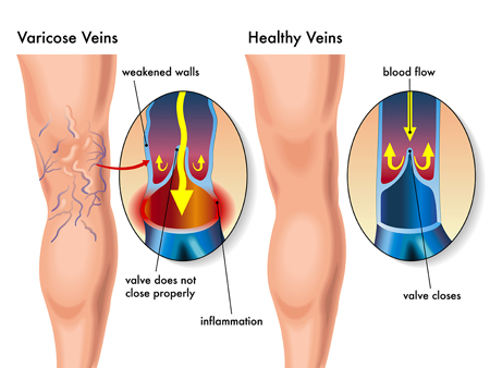 Varicose Vein Diagram