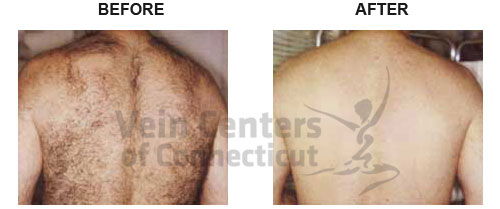 Laser Hair Removal