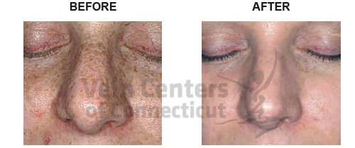 Sunspot Removal