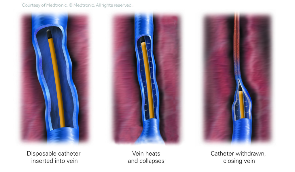 ClosureFast Vein Procedure Illustration