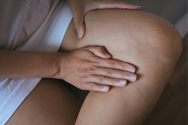 woman with varicose veins