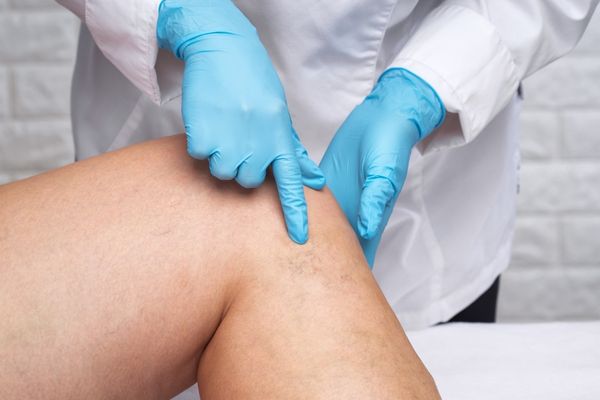 doctor pointing out varicose veins on leg