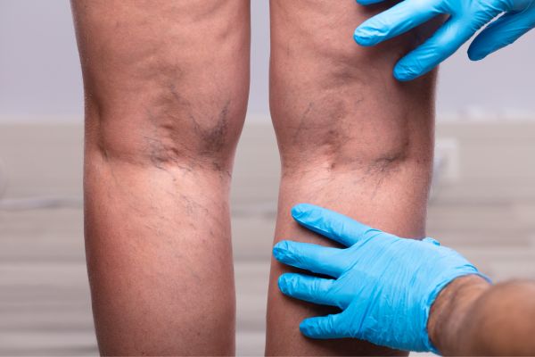 varicose veins on patient's leg