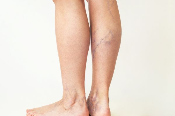 varicose veins on woman's legs