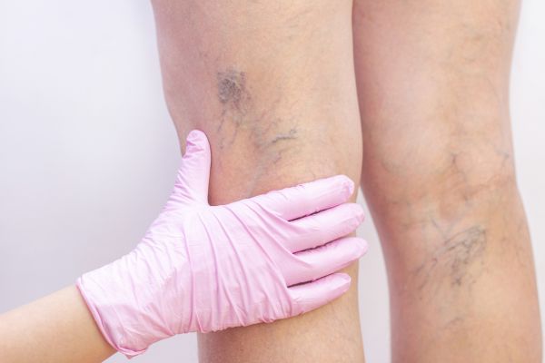 doctor examining varicose veins